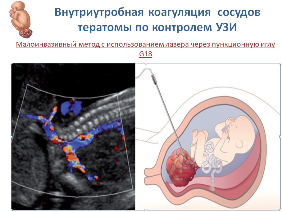 Замершая беременность: причины, диагностика, прерывание | ЦПС Медика